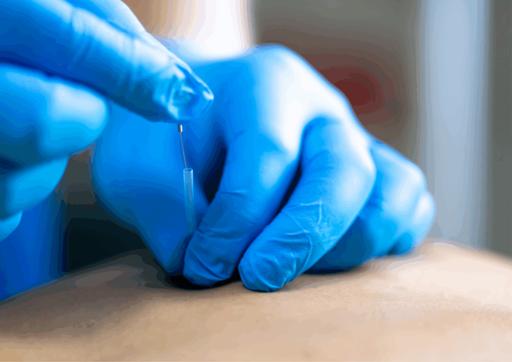 Dry needling treatment at Central Ohio Spine & Joint in Westerville Ohio
