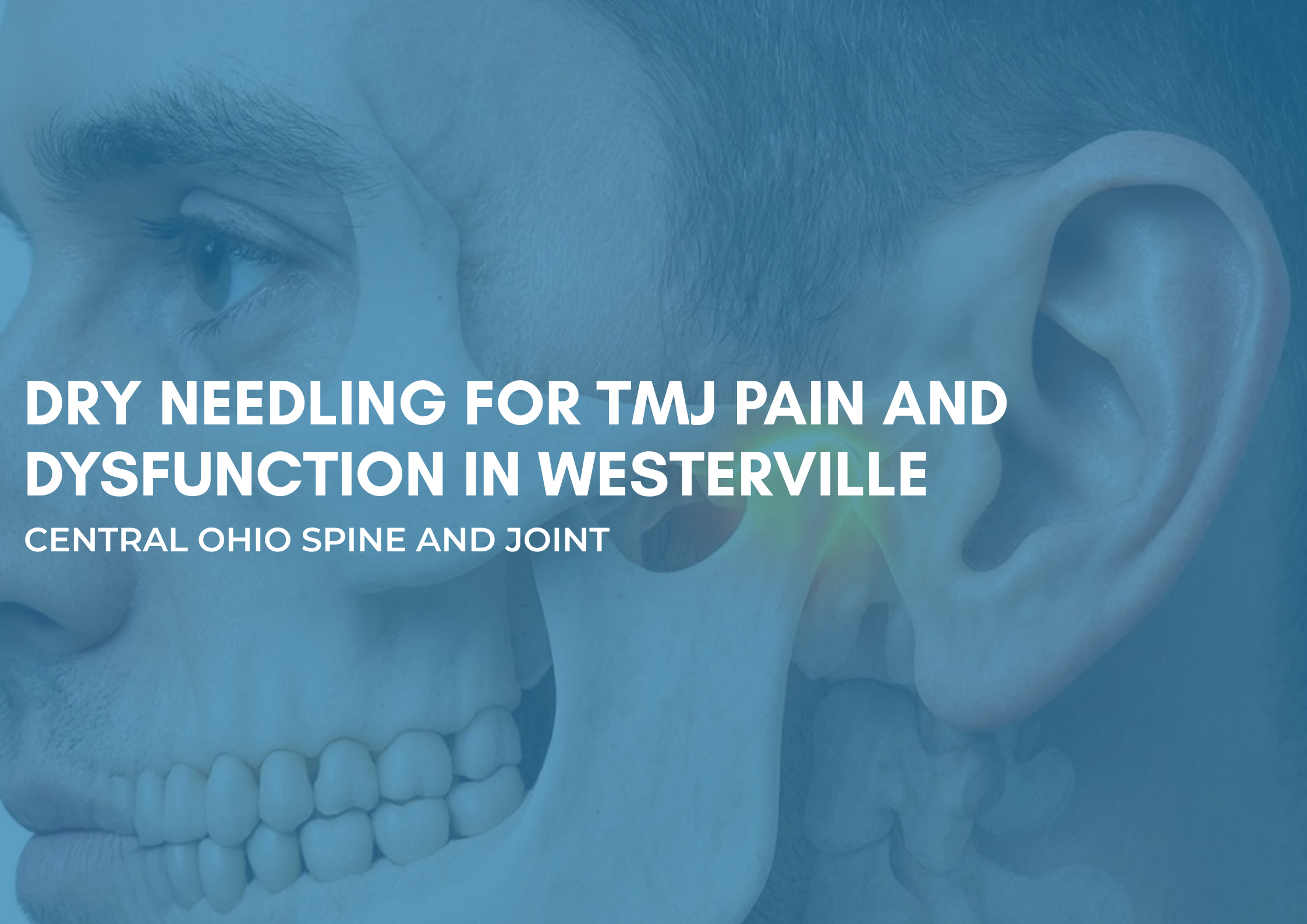 Dry needling therapy for TMJ pain in Westerville Ohio clinic
