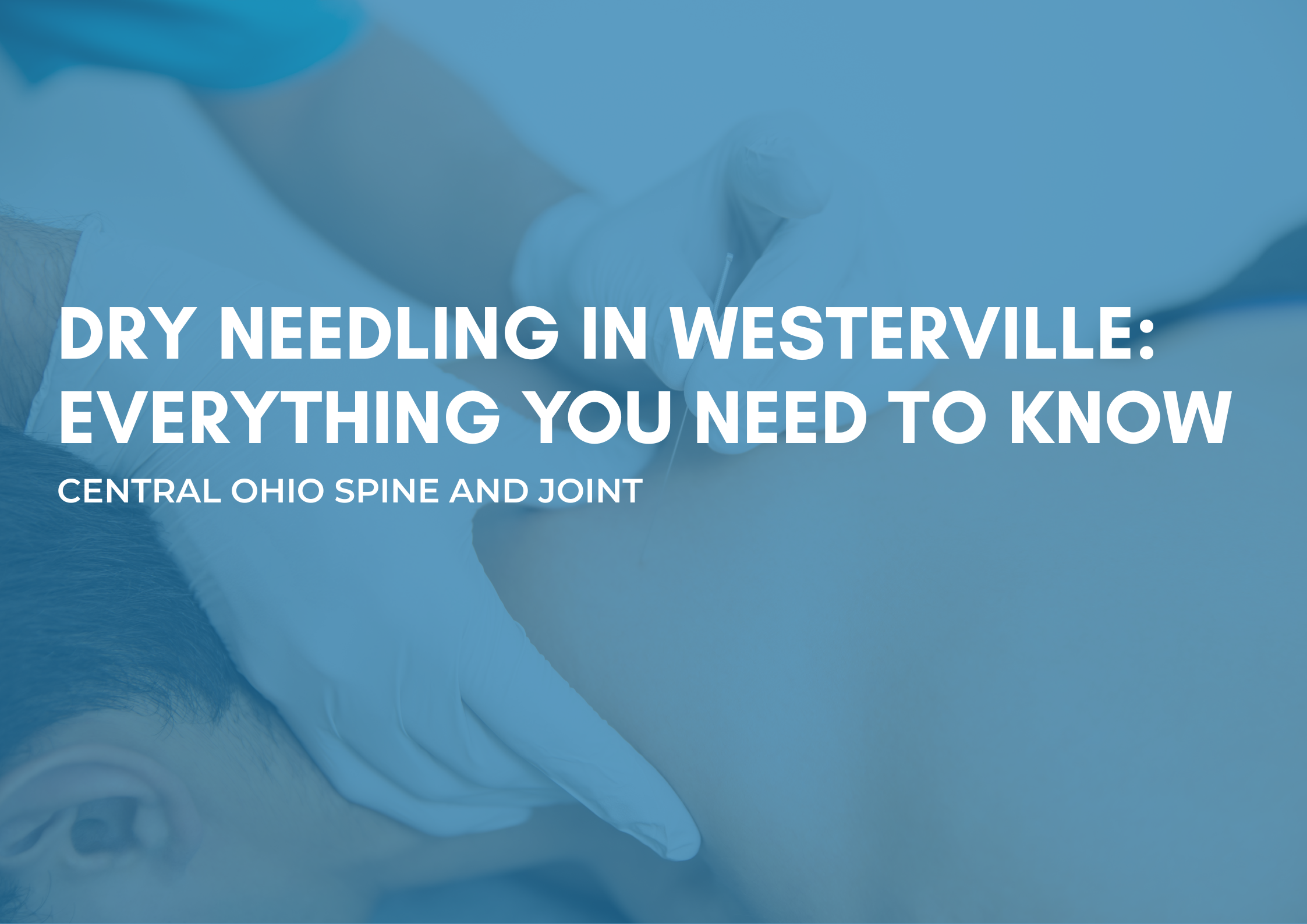 Dry Needling in Westerville Ohio: Everything You Need to Know