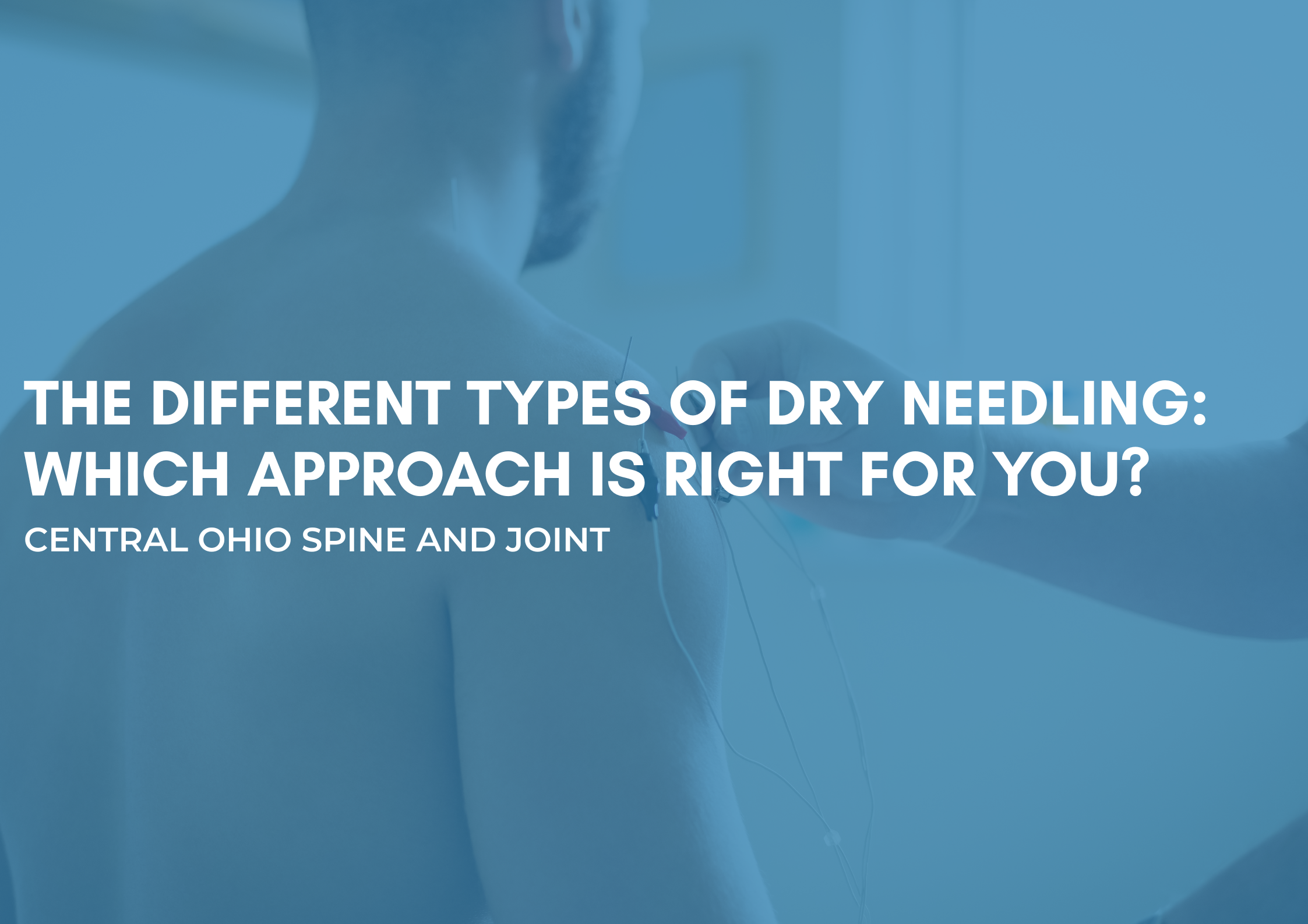 The Different Types of Dry Needling: Which Approach is Right for You?