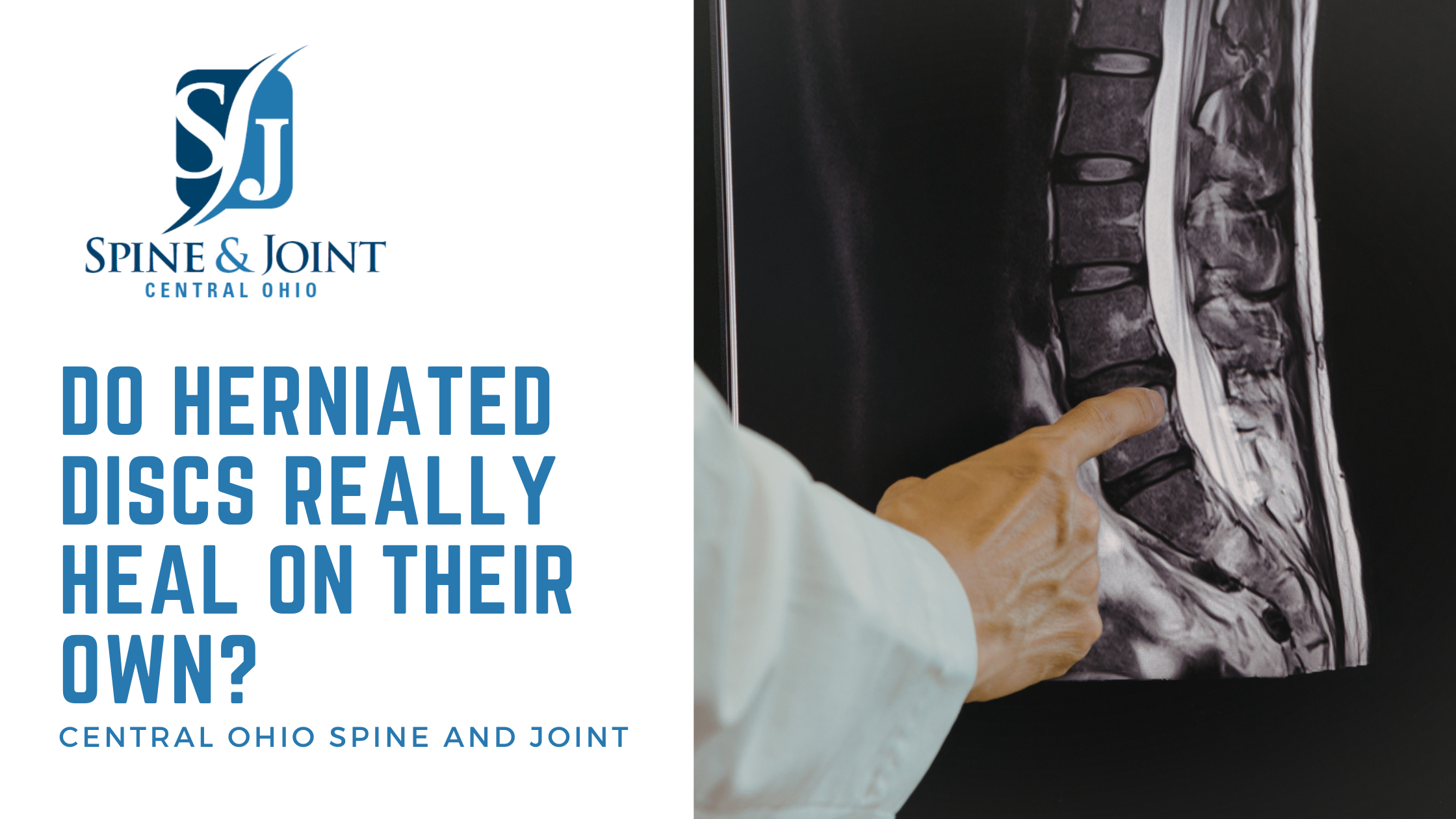 Do Herniated Discs Really Heal on Their Own? Disc herniation ...