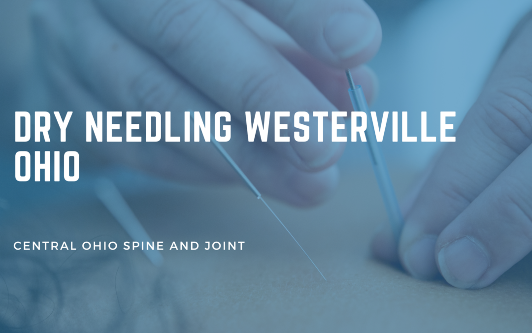 Dry Needling in Westerville OH: What to Expect and Who It Helps
