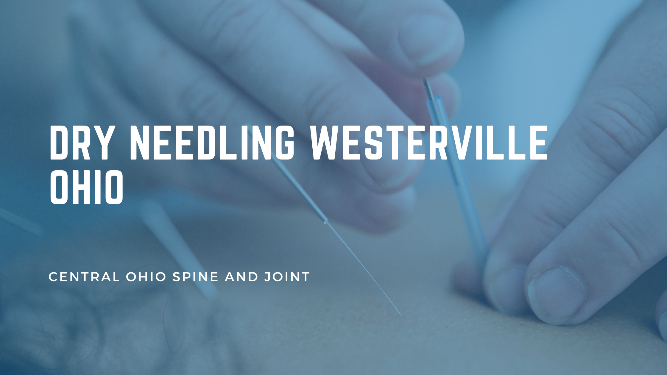 Dry Needling in Westerville OH: What to Expect and Who It Helps
