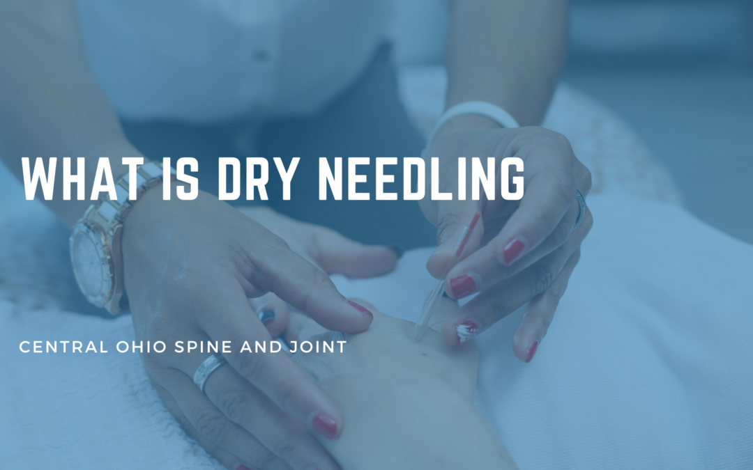 What Is Dry Needling? The Honest Explanation