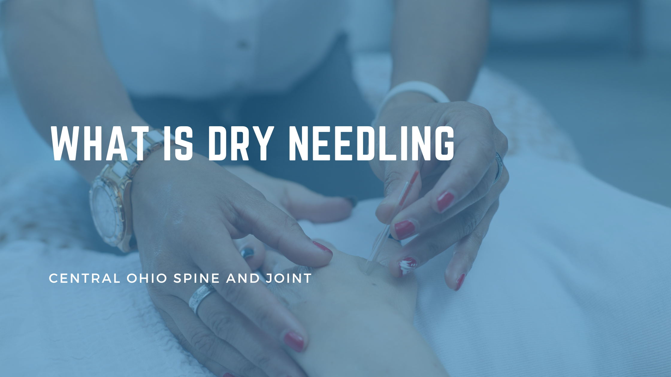 What Is Dry Needling? The Honest Explanation