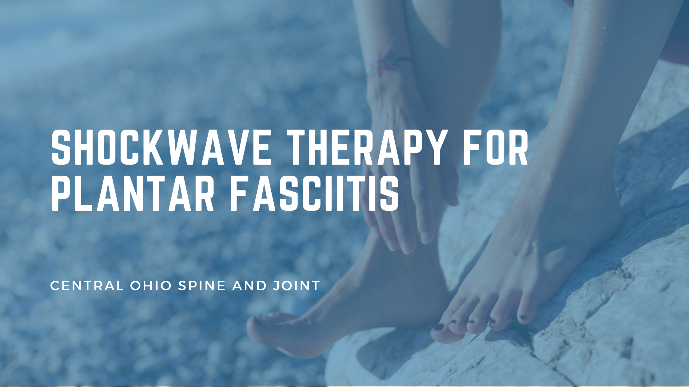 Shockwave Therapy for Plantar Fasciitis: When the Basics Have Stopped Working